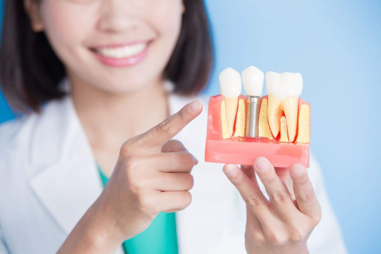 Clínica Dental Helident: Implante dental Sevilla