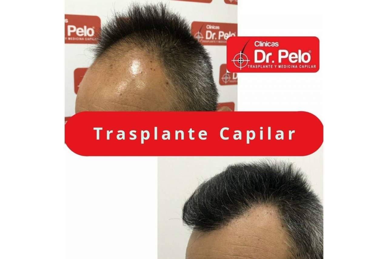 Comentarios sobre el injerto capilar de las Clínicas Dr. Pelo en Sevilla