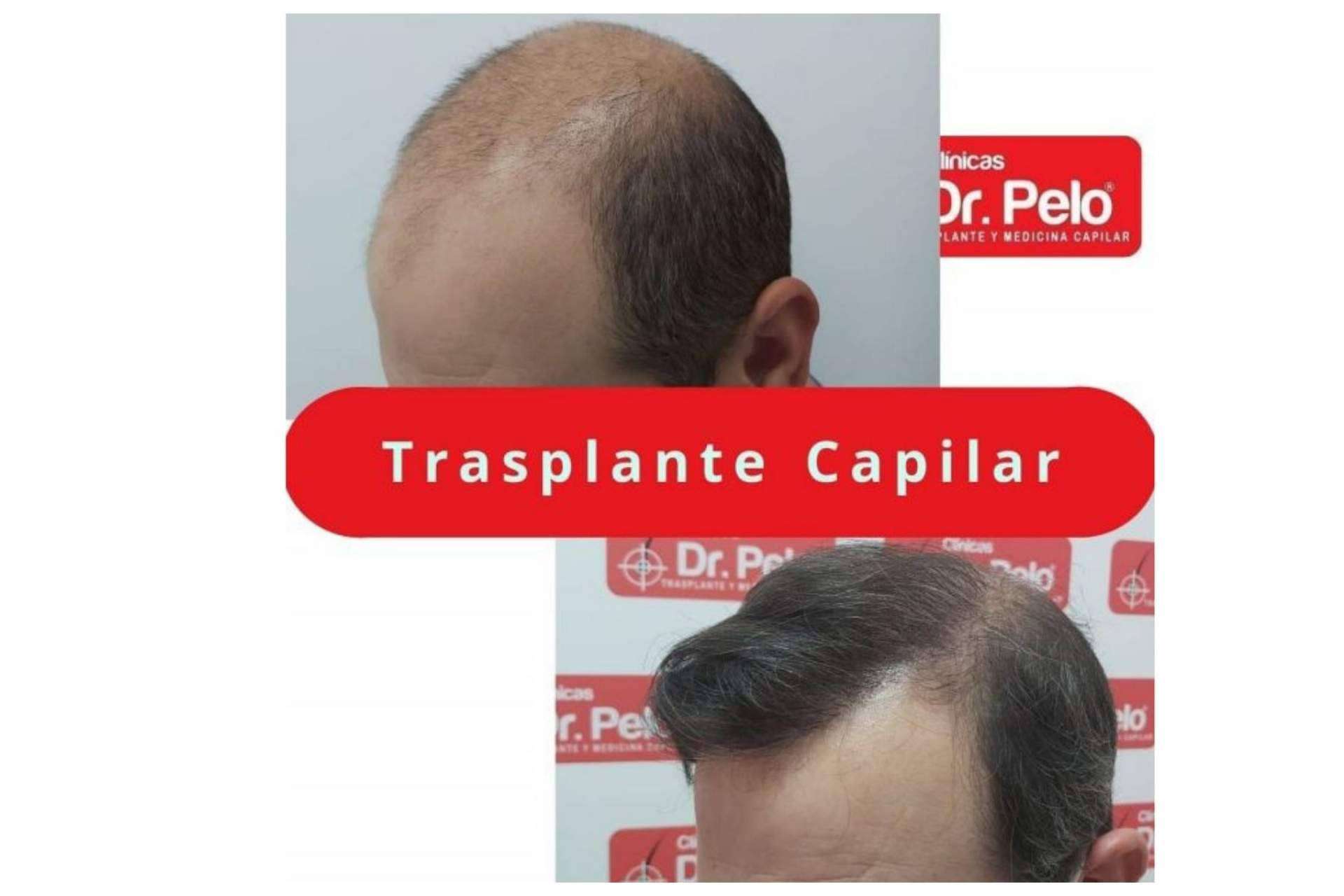 ¿Cuál es la mejor clínica de injerto capilar en Sevilla?: Clínica Dr.Pelo