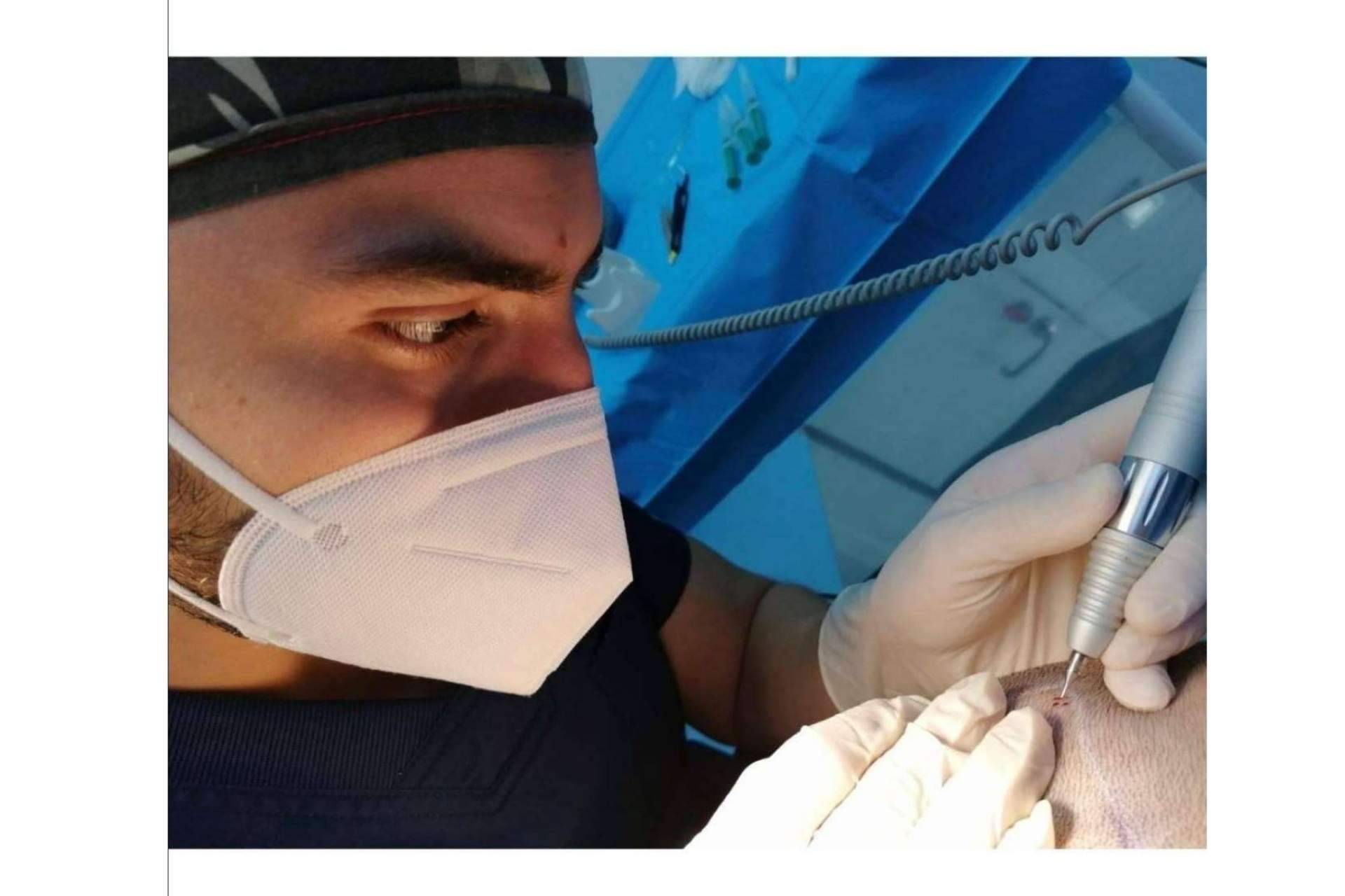 La fase del desierto capilar: ¿Cuándo se cae el pelo implantado?, según Doctor Bern