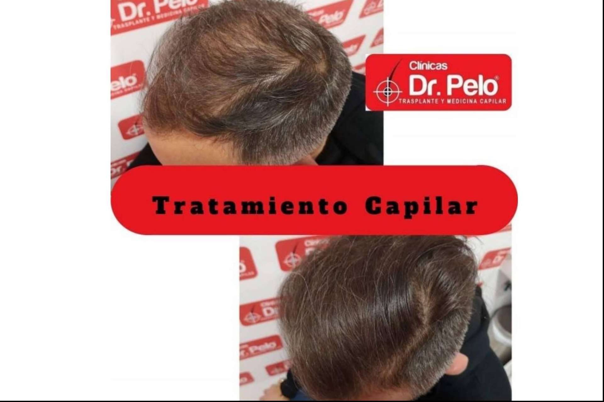 Resultados visibles con el láser capilar LedHair: Dr. Pelo