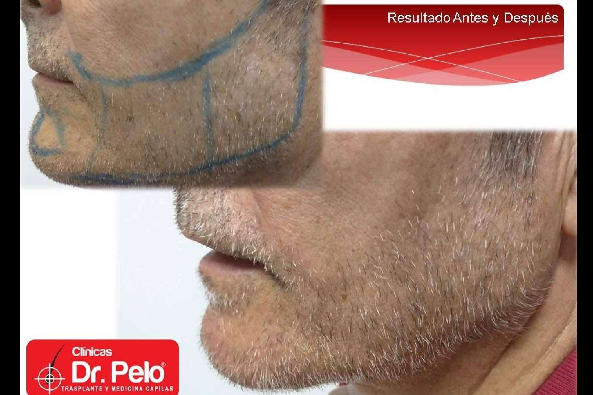 El trasplante de barba de Clínicas Dr. Pelo, uno de los tratamientos con mejores resultados