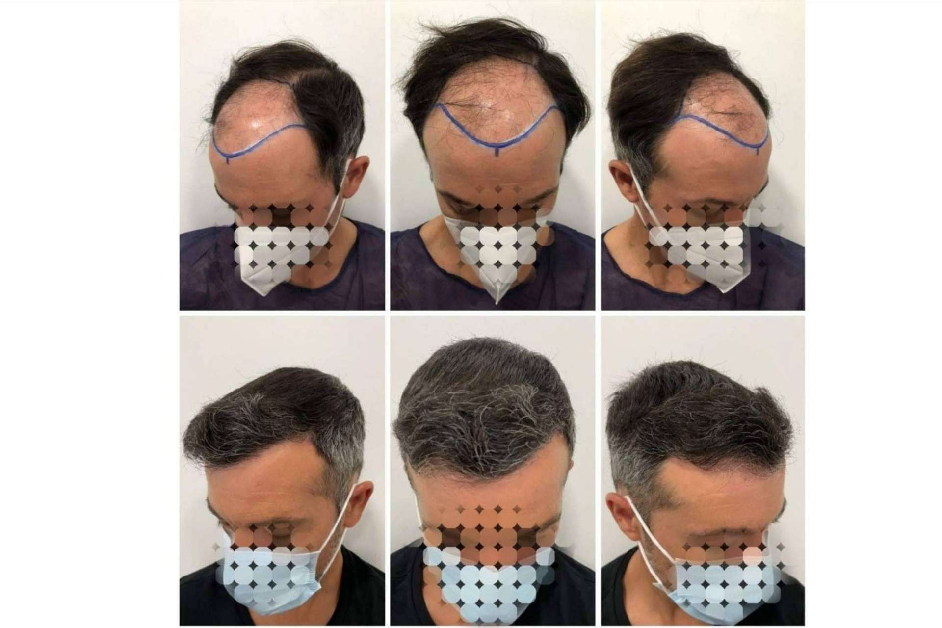 Tratamiento de mesoterapia capilar del Dr. Bruno Jacobovski