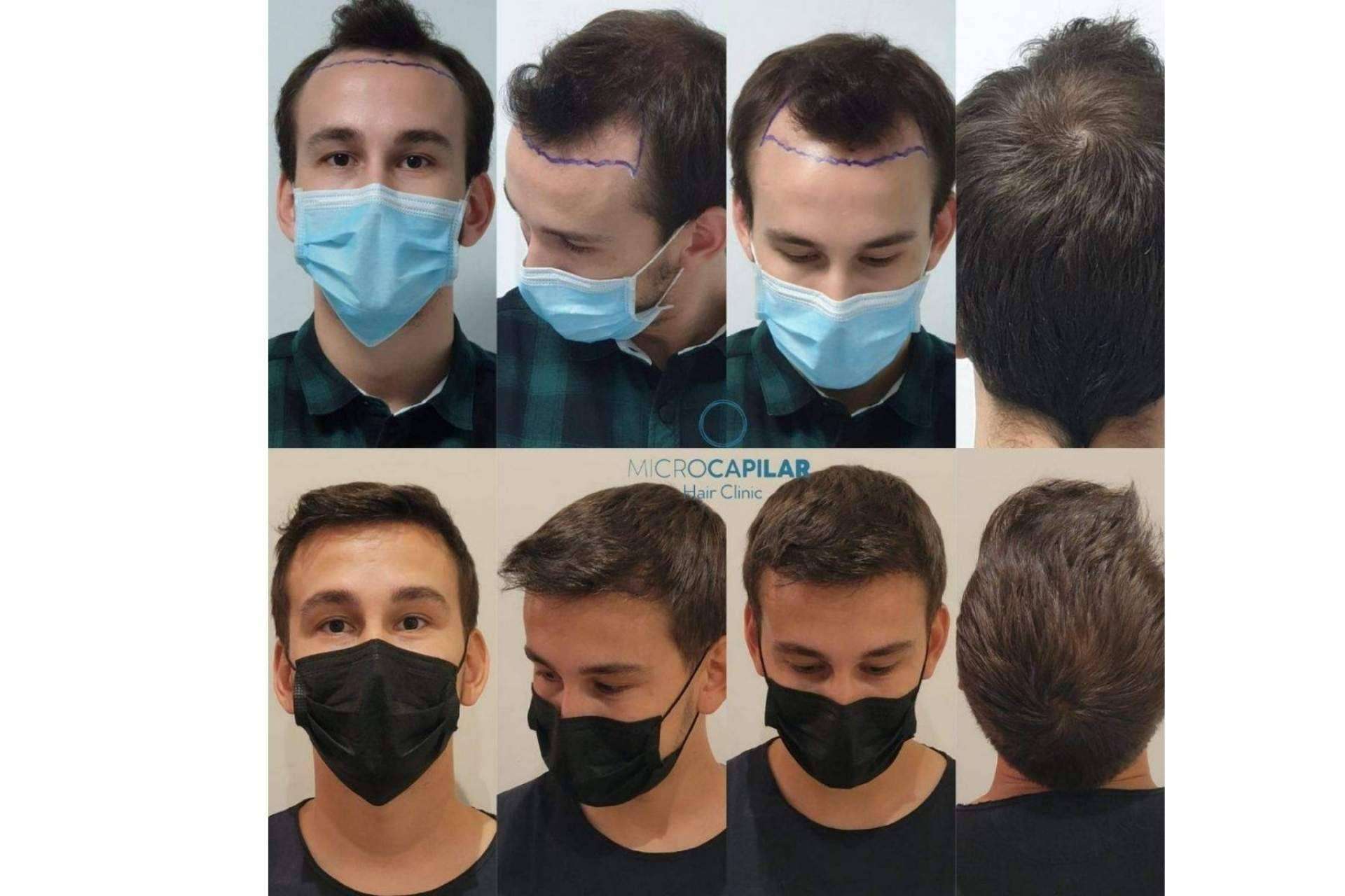 Microcapilar Hair Clinic, las ventajas de realizar un injerto capilar en España