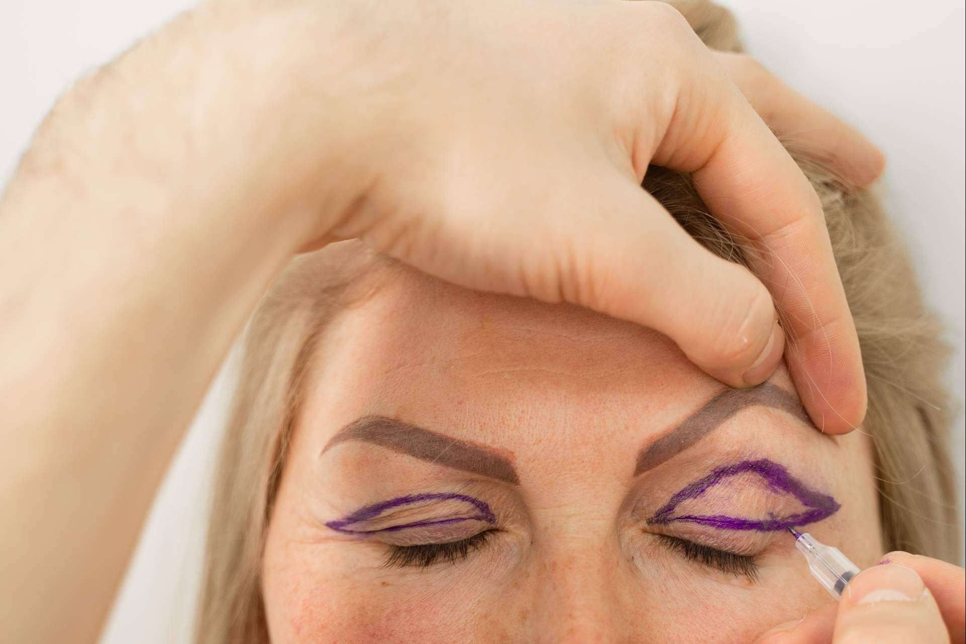 Blefaroplastia sin cirugía con el plasma láser de Alluring Clinic