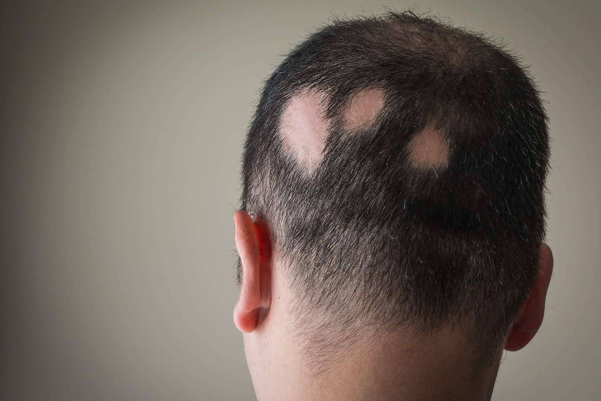 El tratamiento para alopecia areata de Saw Palmetto