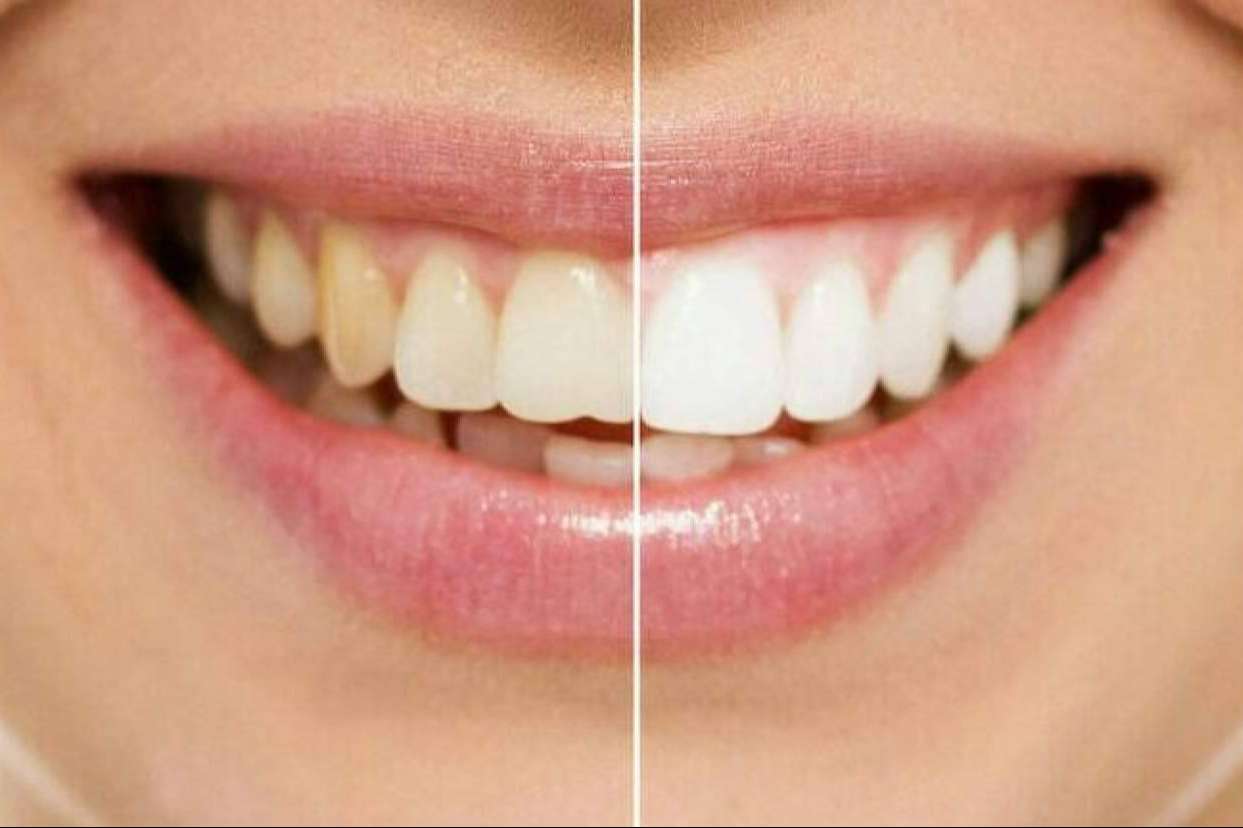 Blanqueamiento dental con los servicios de Cleardent