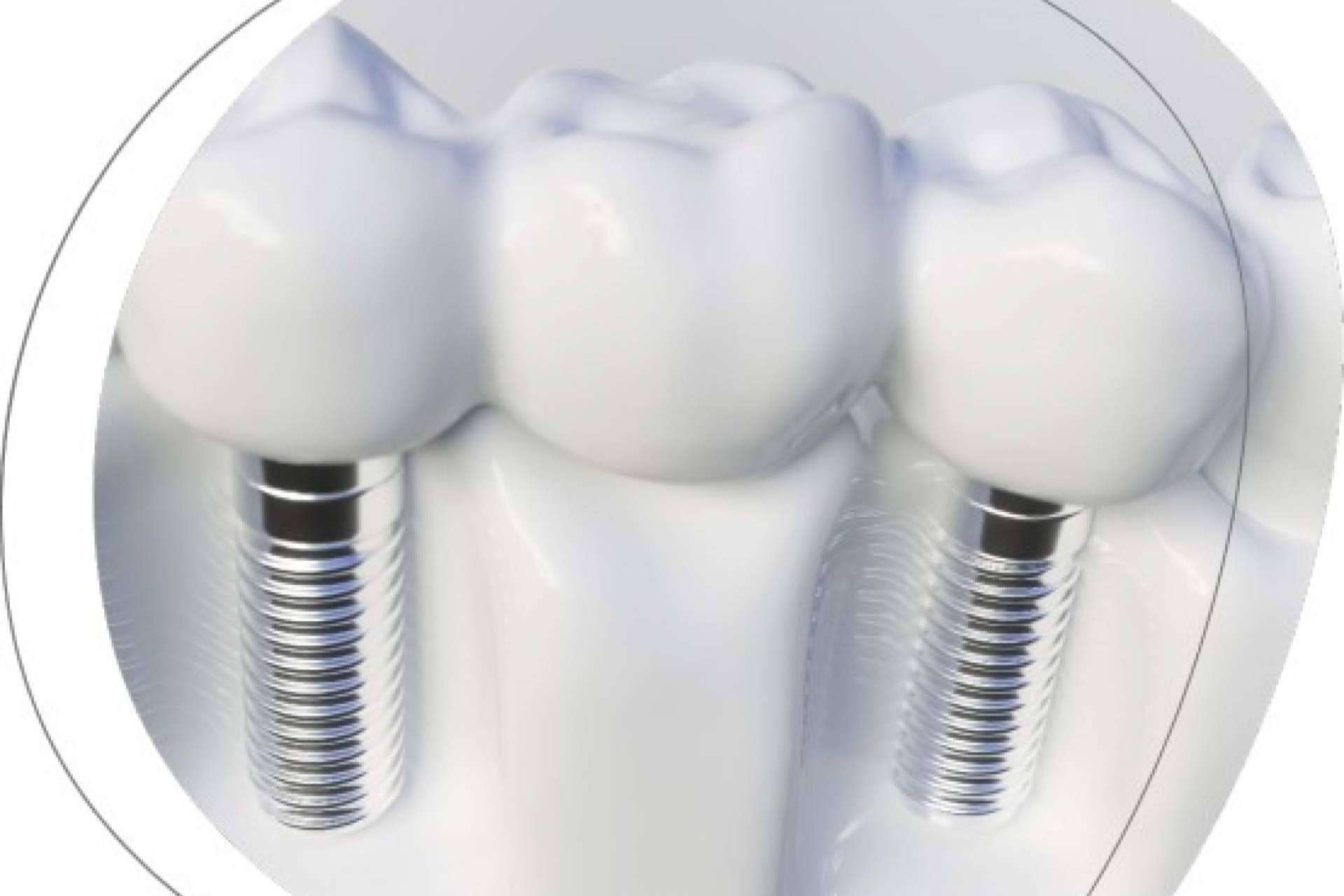 Clínica Dental Agudo Rosa de Albacete, expertos en implantes dentales