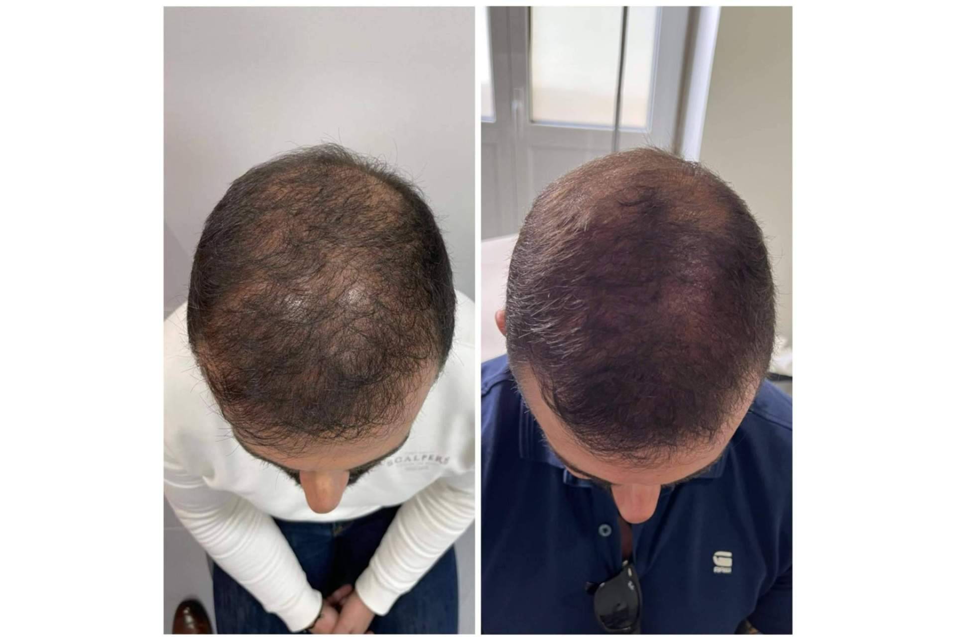 Tratamientos para la caída de pelo, de la mano del centro Cecilia Arthur