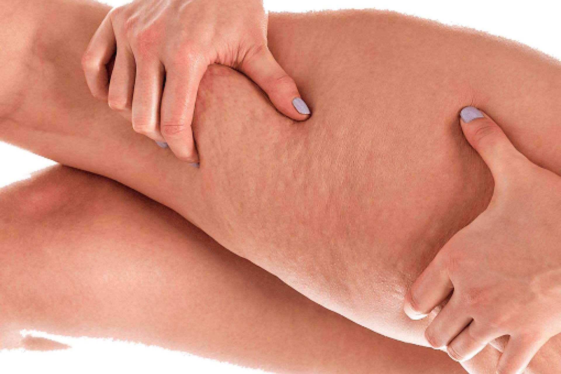 Los sensores especiales de Soluciones ayudan a identificar el nivel de la celulitis, con el objetivo de determinar los procesos y terapias acertadas