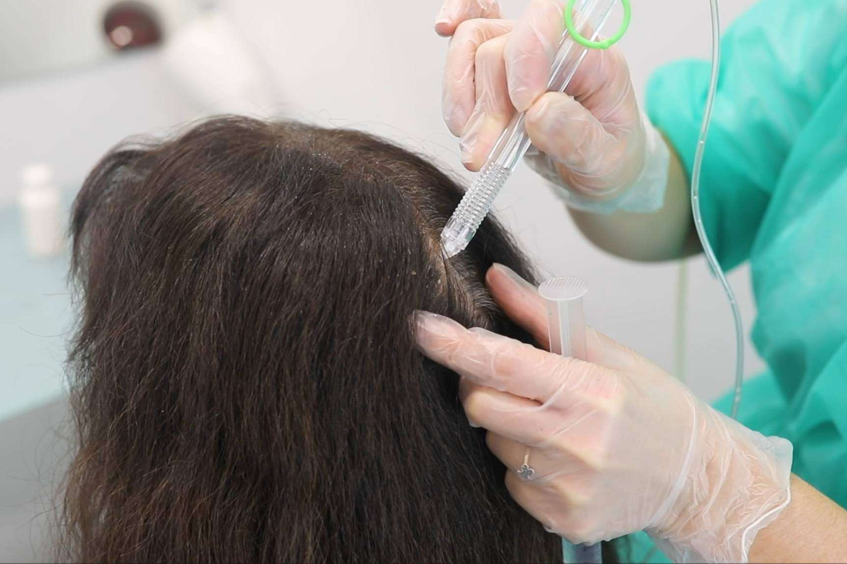 VitaX Regeneración con Minoxidil, el tratamiento de IMD Instituto Médico Dermatológico que frena la caída capilar