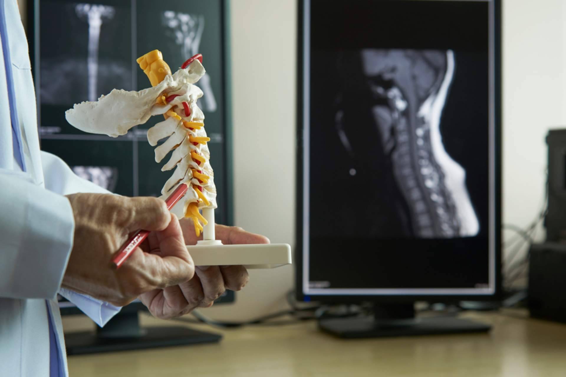 Las causas de la espondilolistesis, por iXalud