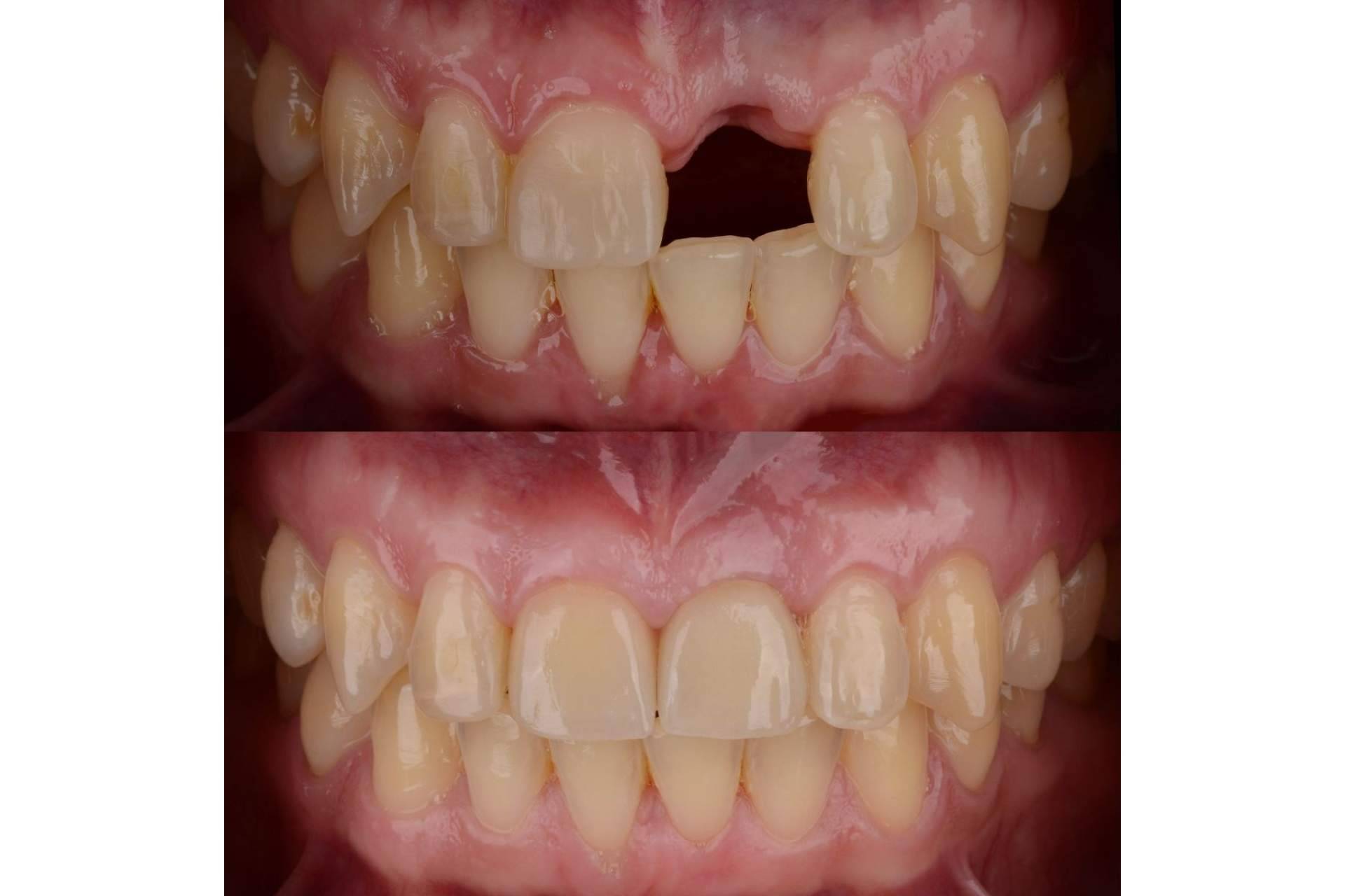 DeltaDent explica los beneficios de los implantes dentales