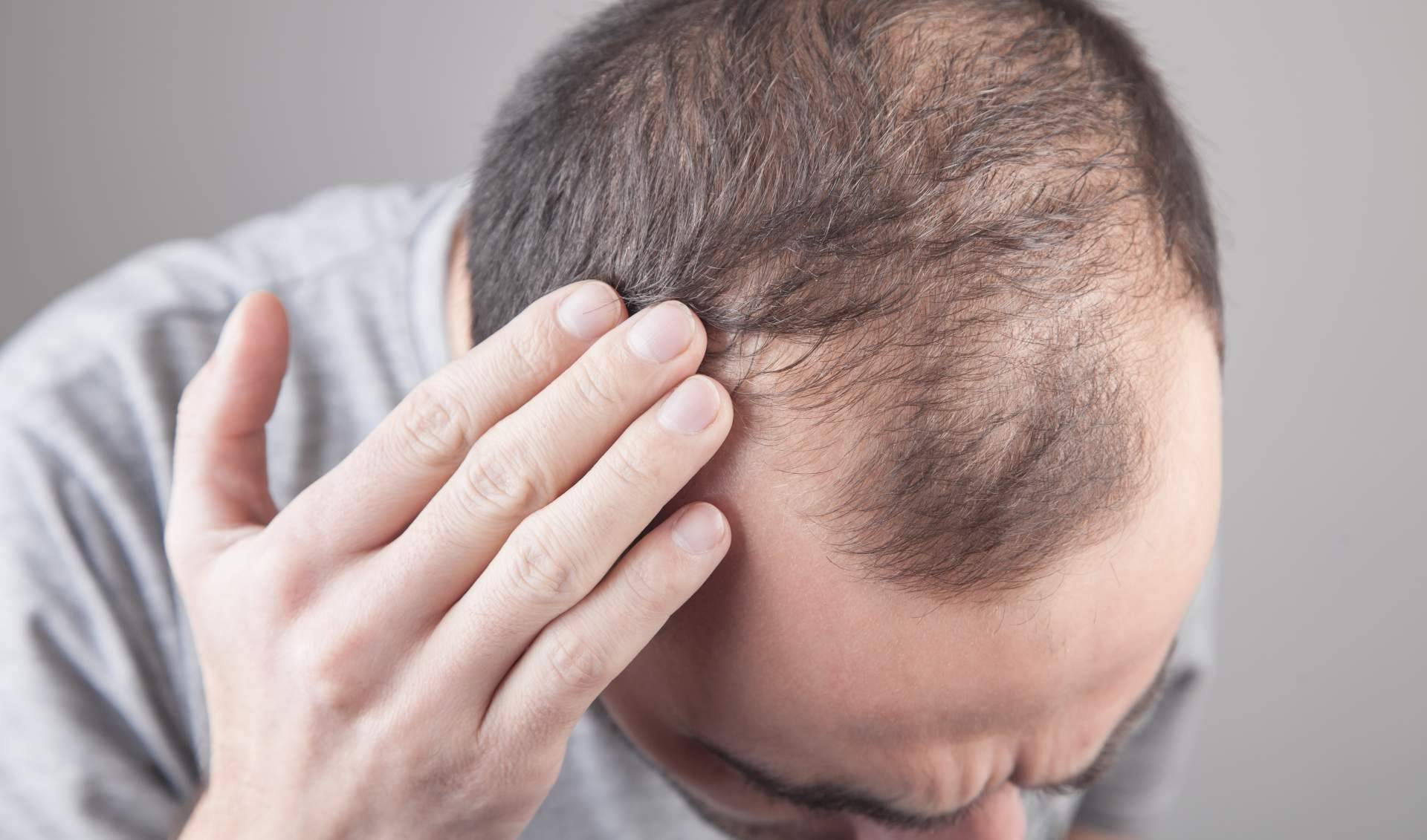 Tratamientos para la alopecia androgénica con Saw Palmetto