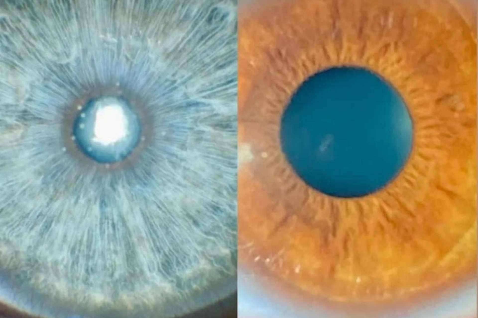 ¿Cuáles son los criterios de selección para cambio de color de ojos con láser?