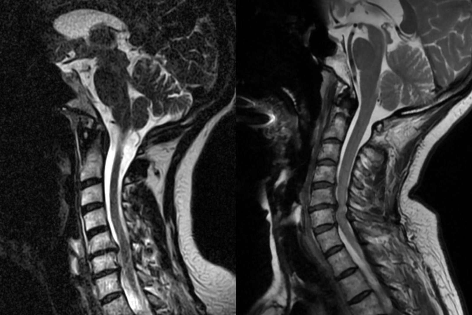 Tratamiento de la hernia discal cervical
